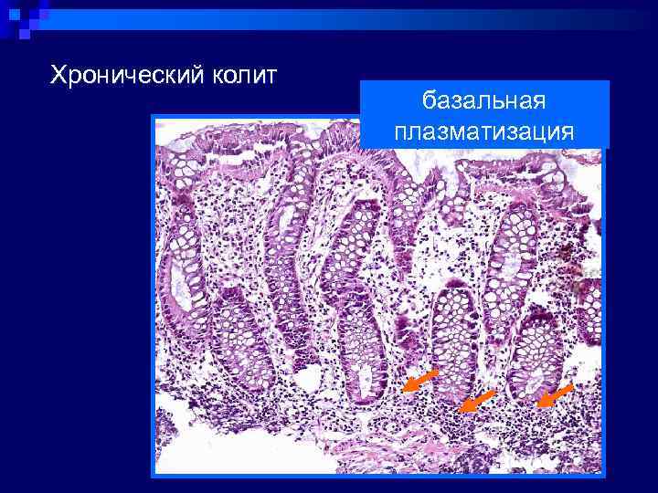 Хронический колит    базальная     плазматизация 