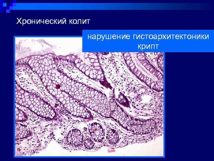 Хронический колит   нарушение гистоархитектоники      крипт 