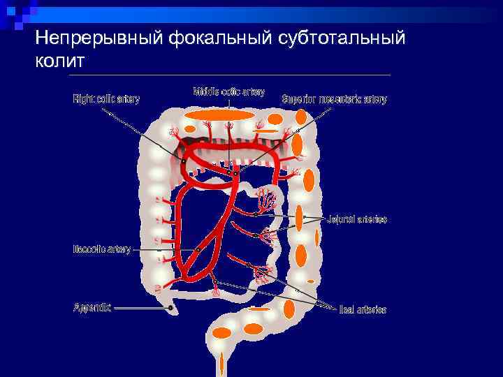 Непрерывный фокальный субтотальный колит 