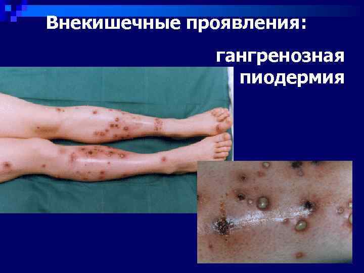 Внекишечные проявления:    гангренозная   пиодермия 