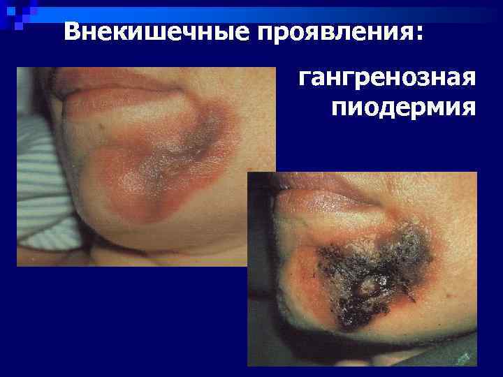 Внекишечные проявления:    гангренозная   пиодермия 