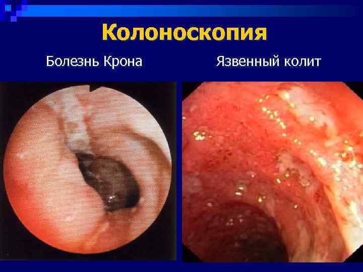   Колоноскопия Болезнь Крона  Язвенный колит 