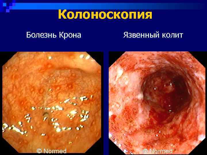   Колоноскопия Болезнь Крона  Язвенный колит 