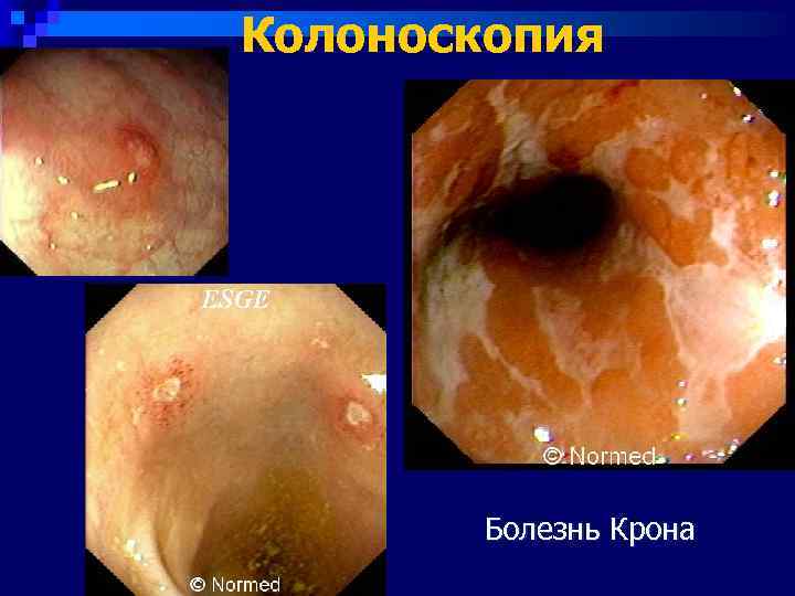 Колоноскопия   Болезнь Крона 