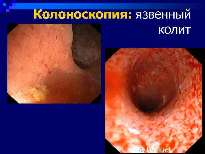 Колоноскопия: язвенный    колит 