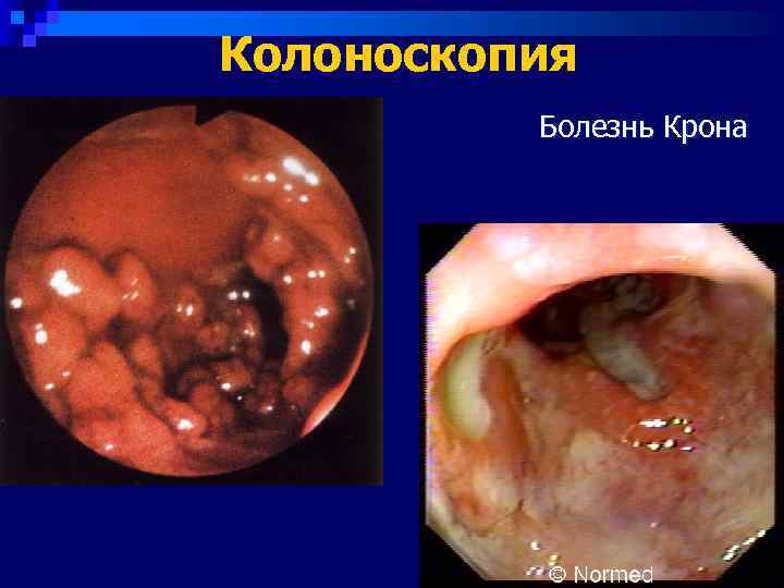 Болезнь крона стол 4