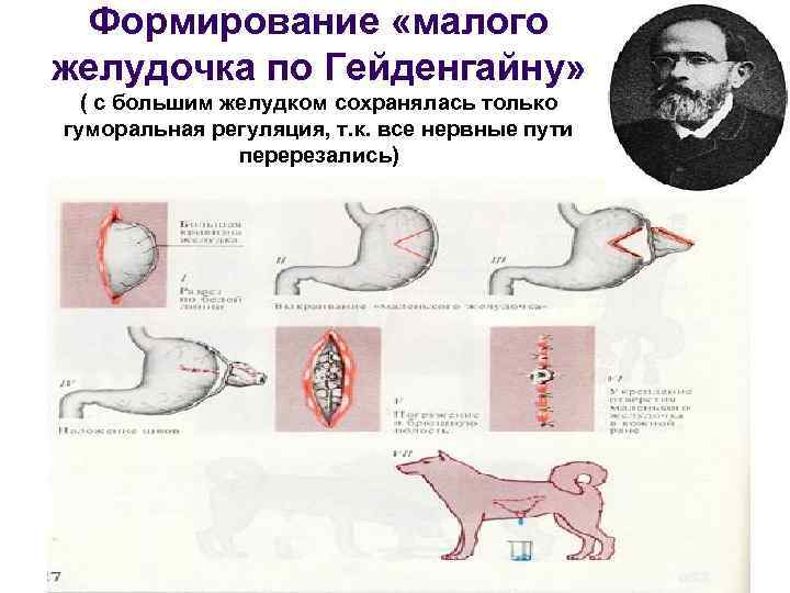  Формирование «малого желудочка по Гейденгайну»  ( с большим желудком сохранялась только гуморальная