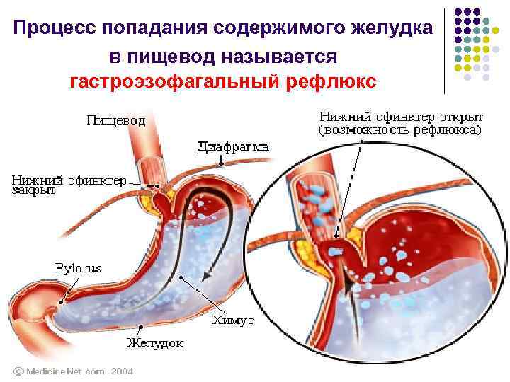 Процесс попадания содержимого желудка   в пищевод называется гастроэзофагальный рефлюкс 