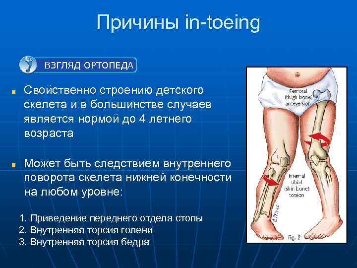     Причины in-toeing  ВЗГЛЯД ОРТОПЕДА Свойственно строению детского скелета и