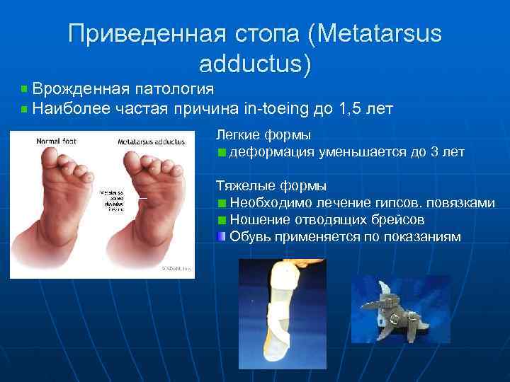   Приведенная стопа (Metatarsus    adductus) Врожденная патология Наиболее частая причина