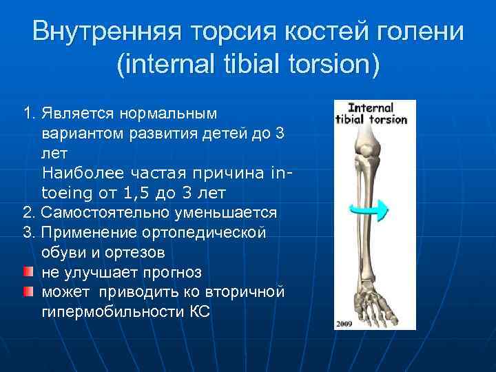 Внутренняя торсия костей голени   (internal tibial torsion) 1. Является нормальным вариантом
