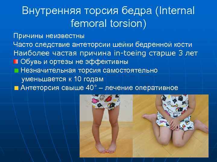  Внутренняя торсия бедра (Internal  femoral torsion) Причины неизвестны Часто следствие антеторсии шейки