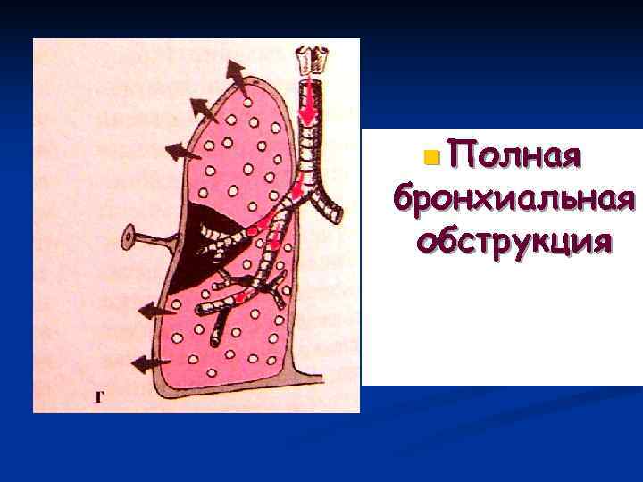  n Полная бронхиальная обструкция 