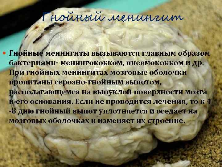    Гнойный менингит  Гнойные менингиты вызываются главным образом бактериями- менингококком, пневмококком