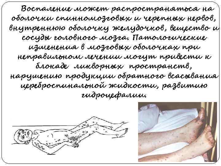   Воспаление может распространяться на оболочки спинномозговых и черепных нервов, внутреннюю оболочку желудочков,