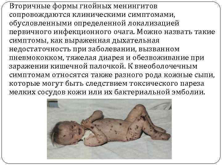 Вторичные формы гнойных менингитов сопровождаются клиническими симптомами, обусловленными определенной локализацией первичного инфекционного очага. Можно