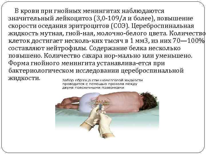  В крови при гнойных менингитах наблюдаются значительный лейкоцитоз (3, 0 109/л и более),