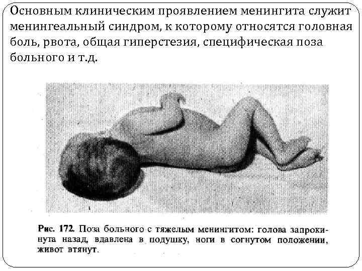 Основным клиническим проявлением менингита служит менингеальный синдром, к которому относятся головная боль, рвота, общая