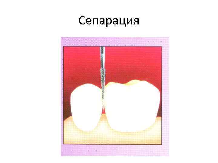 Сепарация 