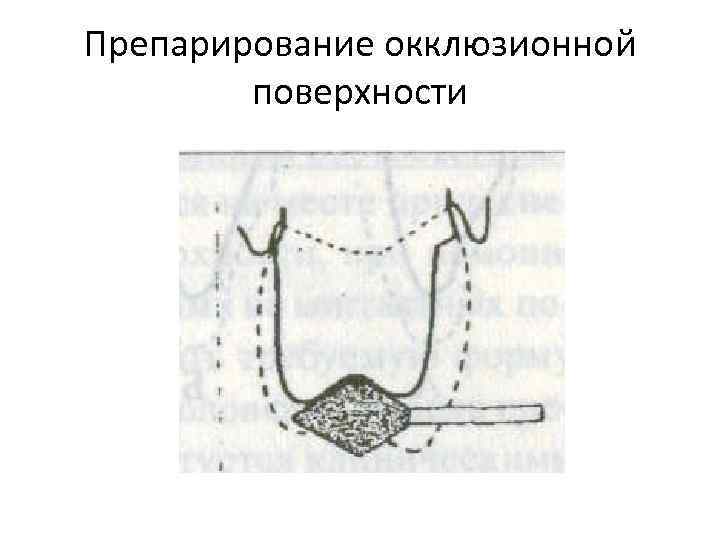 Окклюзионная схема кувата