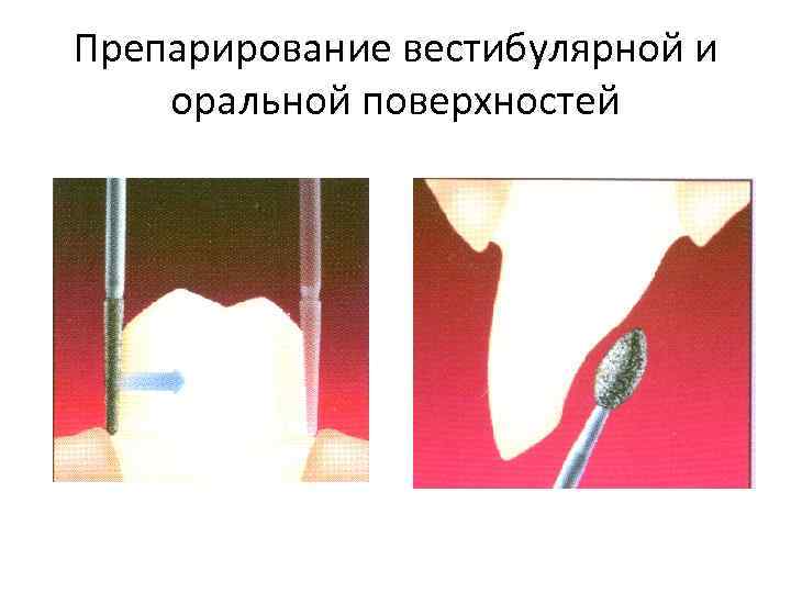 Препарирование вестибулярной и оральной поверхностей 