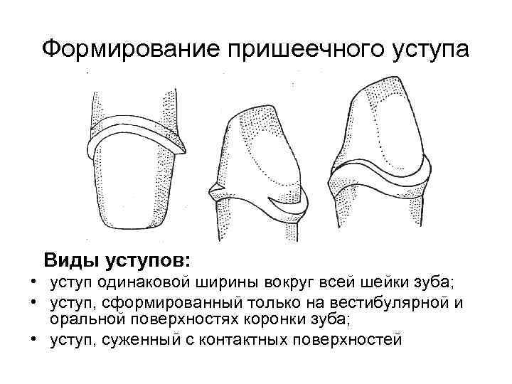 Препарирование под металлокерамическую коронку с уступом в картинках