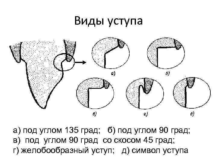 Препарирование под металлическую коронку схема