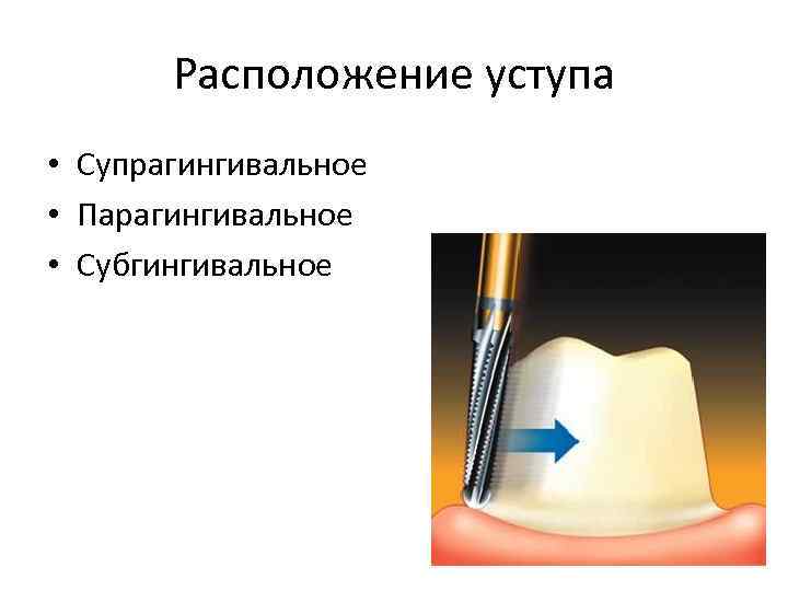 Расположение уступа • Супрагингивальное • Парагингивальное • Субгингивальное 