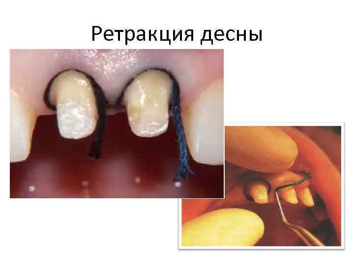 Ретракция десны 