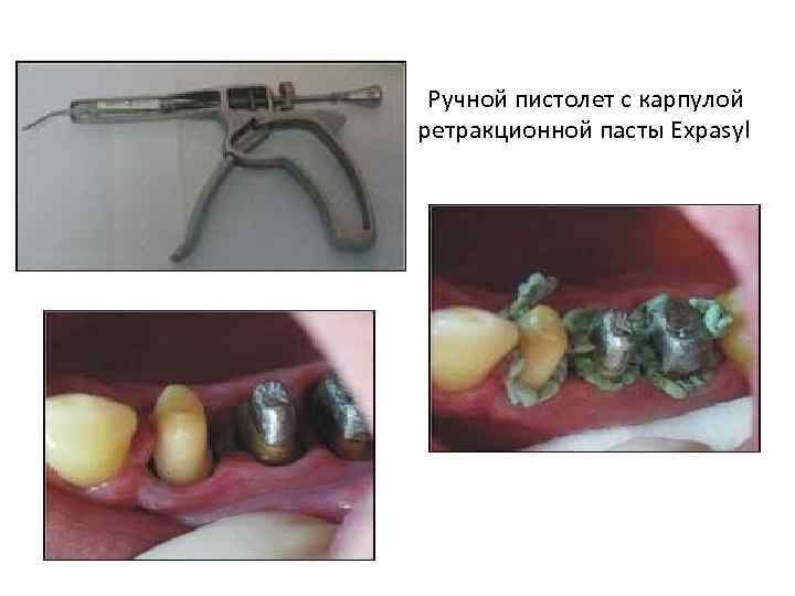 Ручной пистолет с карпулой ретракционной пасты Expasyl 