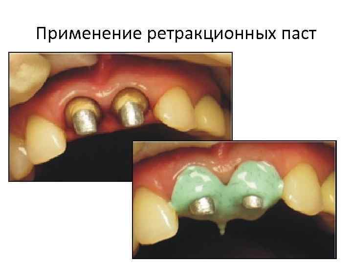 Применение ретракционных паст • 