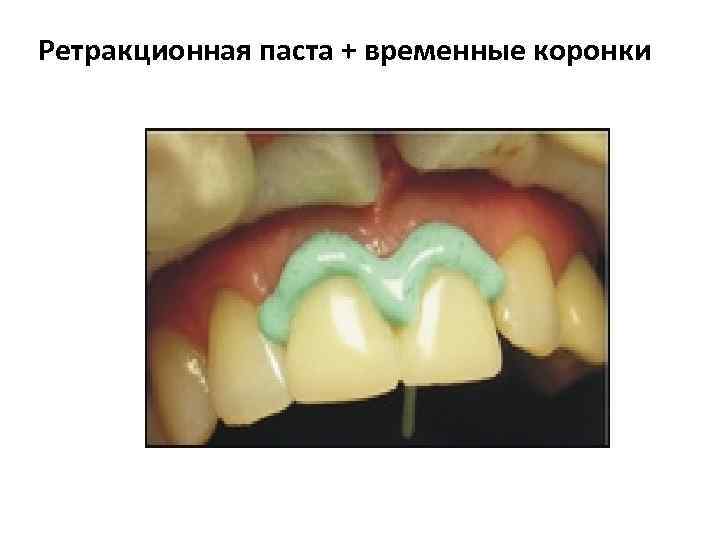 Ретракционная паста + временные коронки 