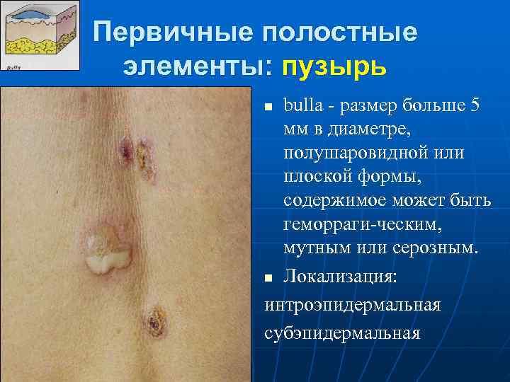 Первичные полостные  элементы: пузырь  n bulla  размер больше 5  