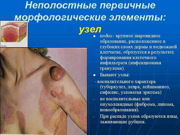  Неполостные первичные морфологические элементы:  узелnodus– крупное шаровидное     n