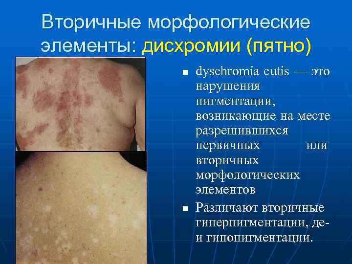 Вторичные морфологические элементы: дисхромии (пятно)    n  dyschromia cutis — это