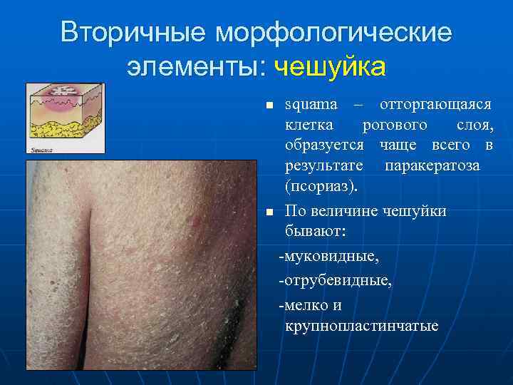 Вторичные морфологические элементы: чешуйка   n squama – отторгающаяся    клетка