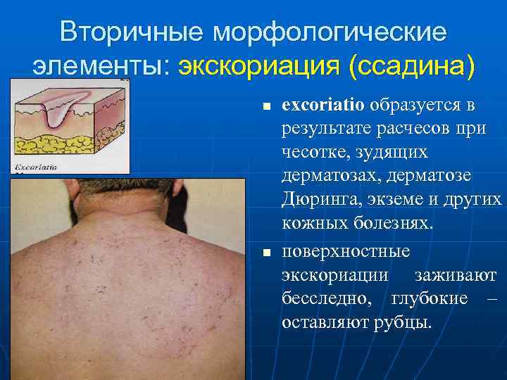  Вторичные морфологические элементы: экскориация (ссадина)   n  excoriatio образуется в 