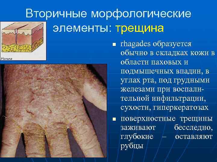 Вторичные морфологические элементы: трещина   n  rhagades образуется   обычно в