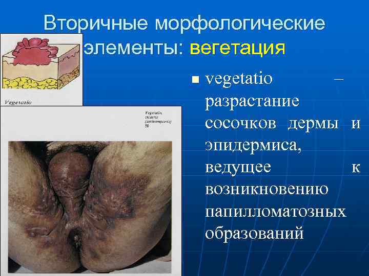 Вторичные морфологические элементы: вегетация   n  vegetatio –   разрастание 