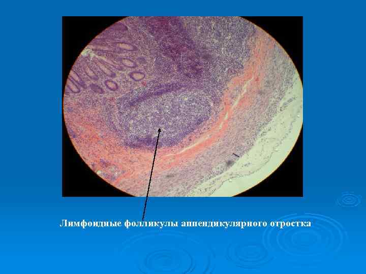 Лимфоидные фолликулы аппендикулярного отростка 