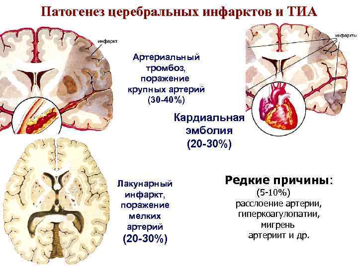 Патогенез церебральных инфарктов и ТИА    Артериальный    тромбоз, 