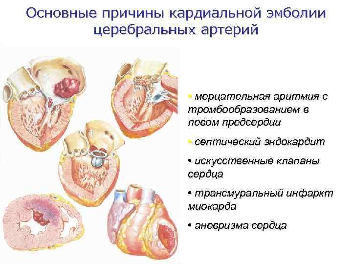 Основные причины кардиальной эмболии   церебральных артерий    • мерцательная аритмия