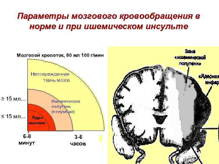  Параметры мозгового кровообращения в  норме и при ишемическом инсульте  Мозговой кровоток,