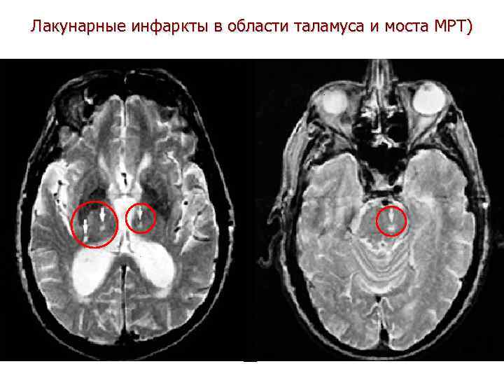 Лакунарные инфаркты в области таламуса и моста МРТ) 