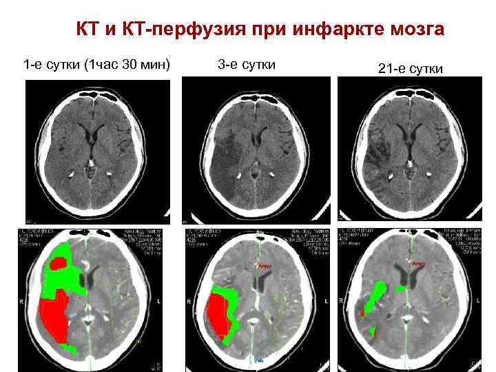   КТ и КТ-перфузия при инфаркте мозга 1 -е сутки (1 час 30