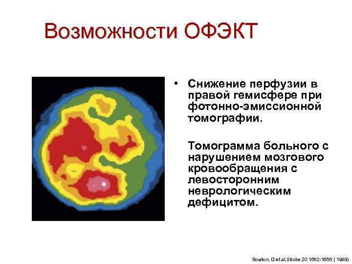 Возможности ОФЭКТ   • Снижение перфузии в   правой гемисфере при 