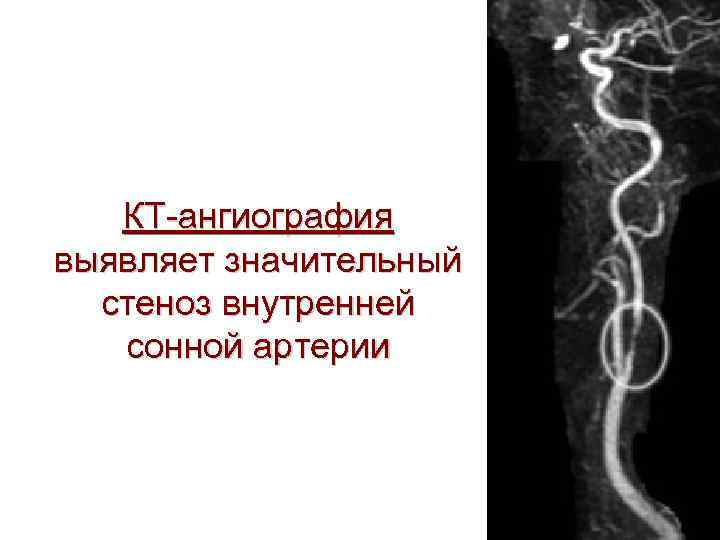   КТ-ангиография выявляет значительный  стеноз внутренней  сонной артерии 