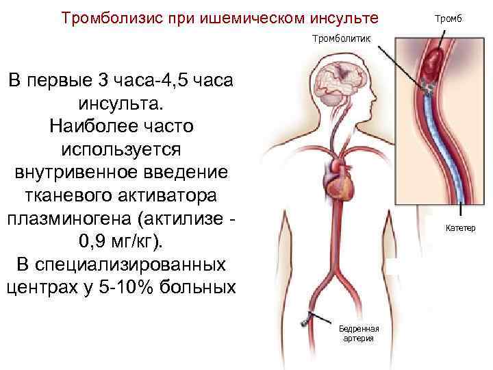  Тромболизис при ишемическом инсульте  Тромб      Тромболитик 