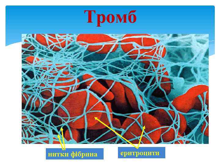    Тромб нитки фібрина  еритроцити 