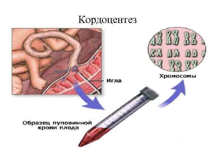 Кордоцентез 